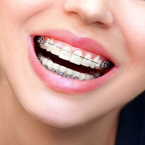 ceramic braces